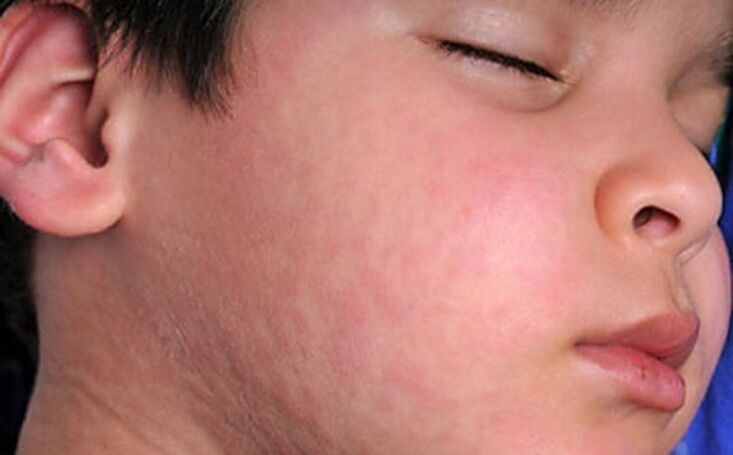 Éruptions cutanées allergiques sur la peau - un symptôme de la présence de vers parasites dans le corps